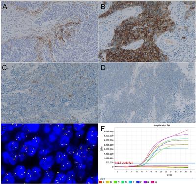 PD-L1, Mismatch Repair Protein, and NTRK Immunohistochemical Expression in Cervical Small Cell Neuroendocrine Carcinoma